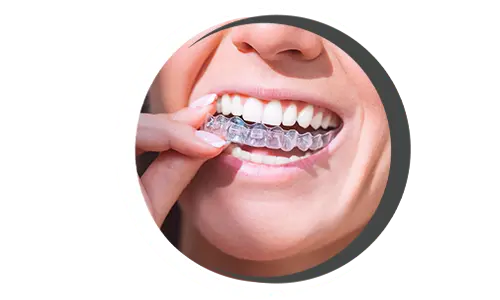 Clearcorrect ClearCorrect aligners, Invisible aligners, Clear teeth straightening