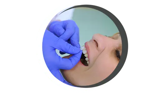 Dental Veneers Dental veneers, Porcelain veneers, Composite resin veneers